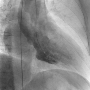 Original cine frame at 3.07 seconds showing ventricular contraction and contrast in the left atrial region on screen-left